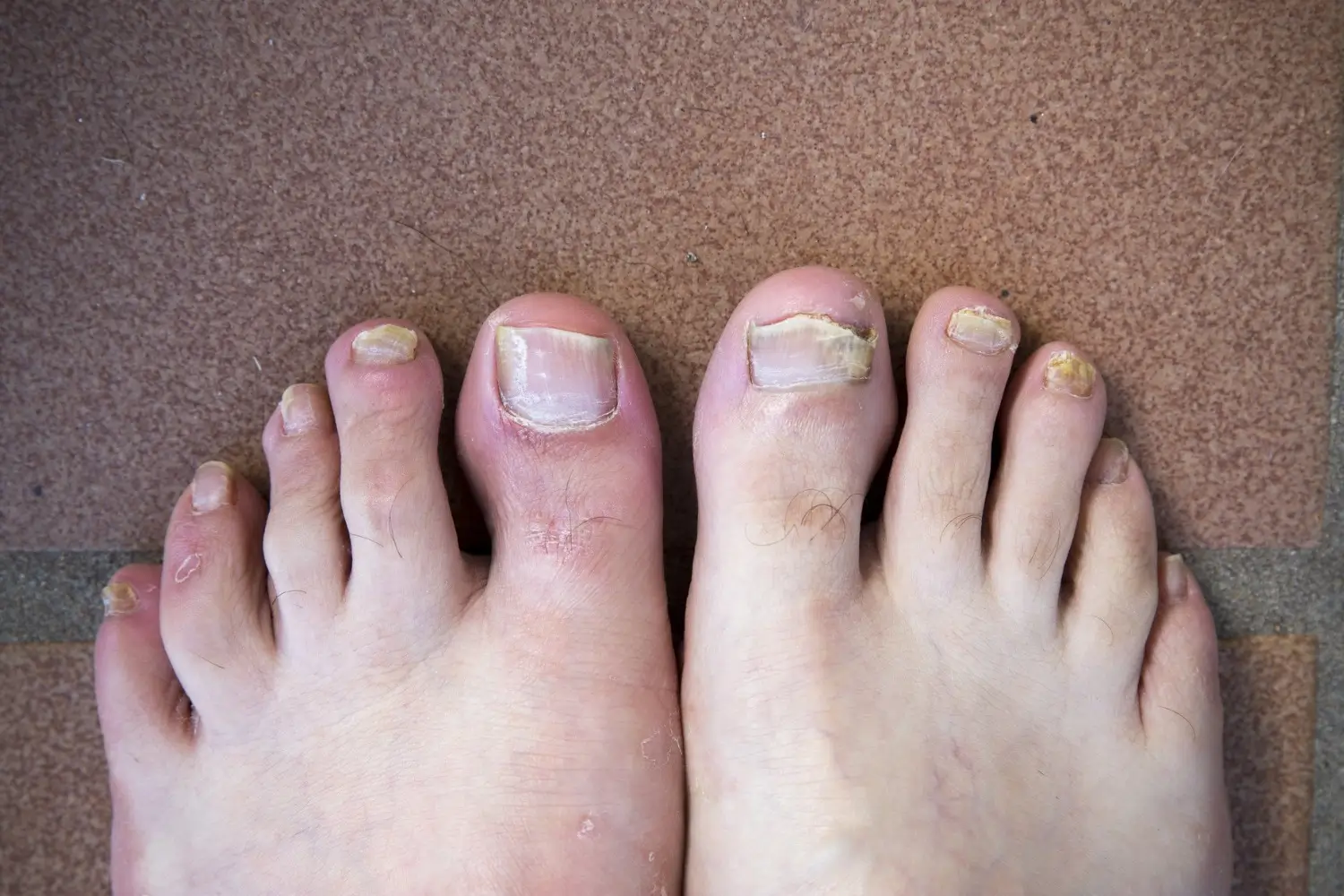 Can I Get a Pedicure if I Have Toe Fungus - Lavish Lux Nail Spa