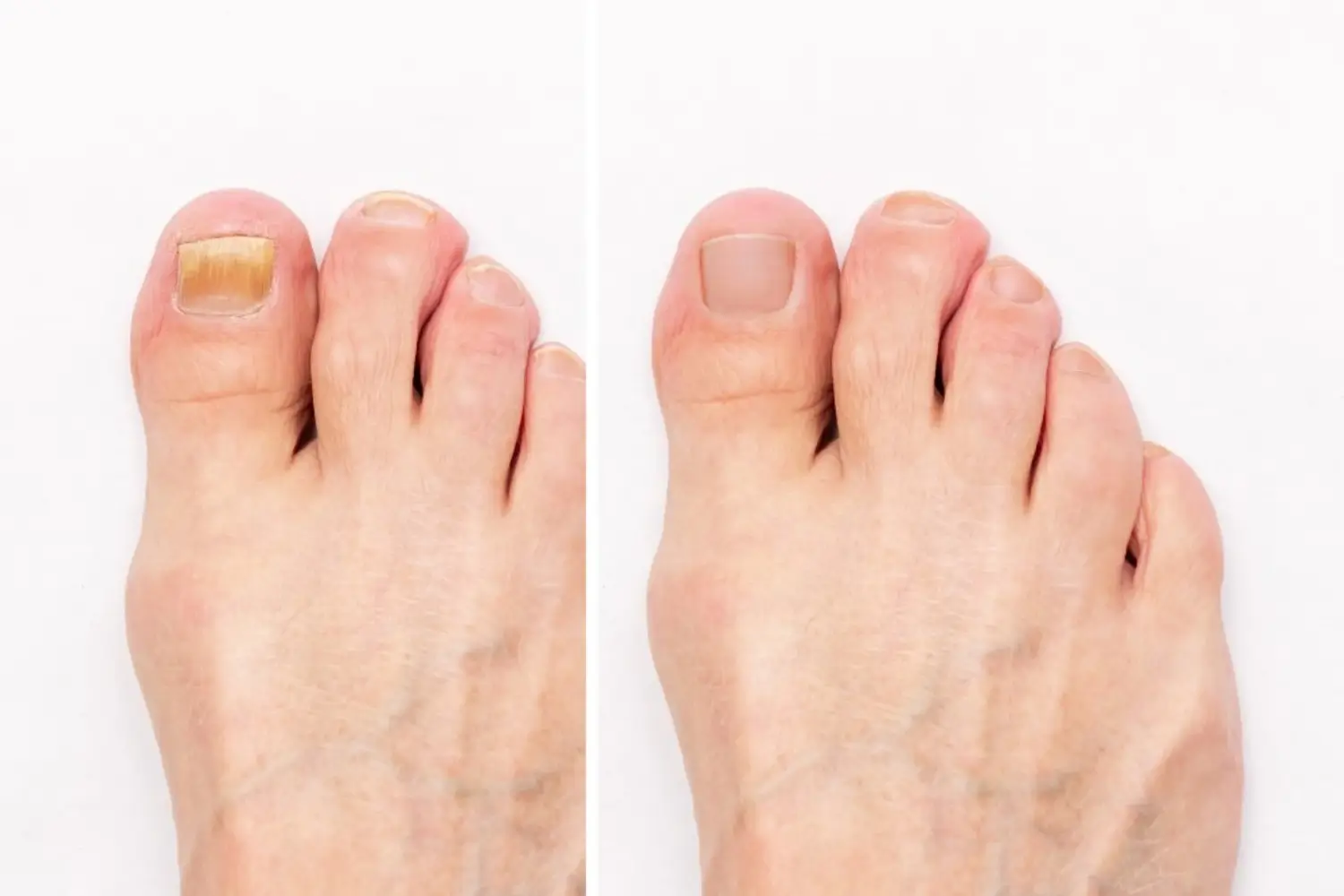 Can You Get a Pedicure if You Have Toenail Fungus - Lavish Lux Nail Spa