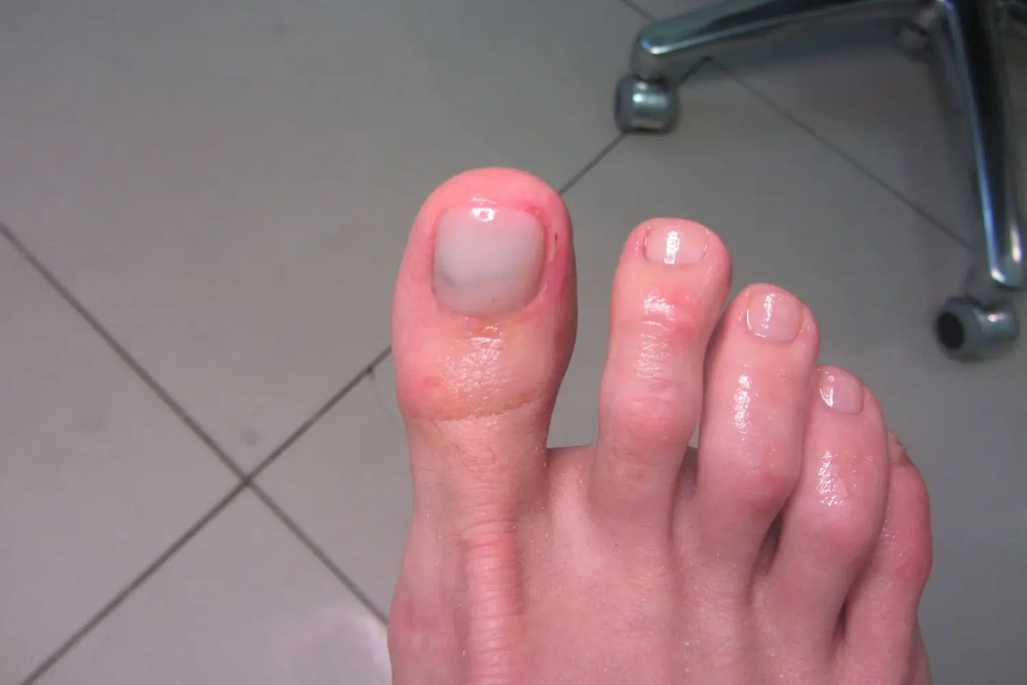 Should I Get a Pedicure if I Have Toenail Fungus - Lavish Lux Nail Spa